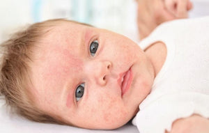 Baby with skin redness possibly due to allergies, highlighting need for nut-free, allergy-friendly snacks.